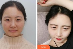 深圳希瑪林順潮眼科醫(yī)院肖月影整形價格表附眼部修復(fù)案例展示