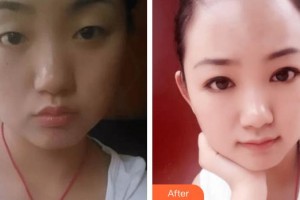 深圳希瑪林順潮眼科醫(yī)院卡夫恩整形價(jià)格表附眼部修復(fù)案例展示