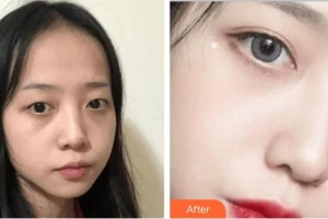 深圳?，斄猪槼毖劭漆t(yī)院哈斯?fàn)栒蝺r(jià)格表附切開雙眼皮案例展示