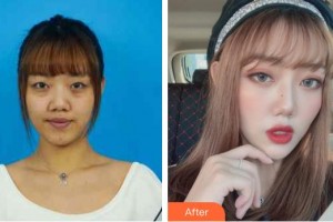 深圳?，斄猪槼毖劭漆t(yī)院卡博整形價格表附內(nèi)切祛眼袋案例展示