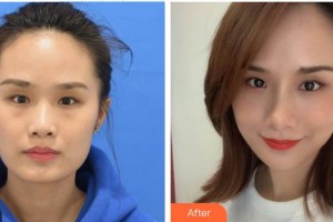 深圳希瑪林順潮眼科醫(yī)院萬竹整形價(jià)格表附激光去眼袋案例展示