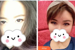 深圳希瑪林順潮眼科醫(yī)院劉泉整形價(jià)格表附眼部綜合案例展示