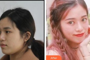 深圳?，斄猪槼毖劭漆t(yī)院尉洋整形價(jià)格表附眼部綜合案例展示