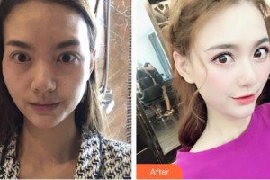 深圳希瑪林順潮眼科醫(yī)院袁野整形價(jià)格表附眼部修復(fù)案例展示