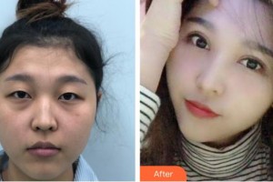 深圳?，斄猪槼毖劭漆t(yī)院林小銘整形價(jià)格表附眼部綜合案例展示