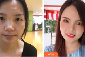 深圳?，斄猪槼毖劭漆t(yī)院舒敏整形價(jià)格表附切開雙眼皮案例展示