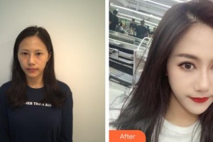 深圳?，斄猪槼毖劭漆t(yī)院石峰整形價(jià)格表附眼部修復(fù)案例展示