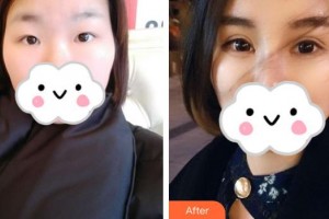 深圳?，斄猪槼毖劭漆t(yī)院范偉整形價(jià)格表附眼部綜合案例展示