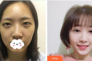 深圳華夏眼科醫(yī)院韓冰整形價(jià)格表附切開雙眼皮案例展示