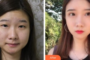 深圳?，斄猪槼毖劭漆t(yī)院林妙麗整形價(jià)格表附眼部整形雙眼皮案例展示