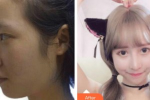 深圳華夏眼科醫(yī)院邢寶剛整形價(jià)格表附眼部綜合案例展示