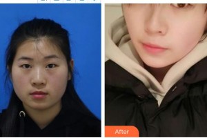 深圳希瑪林順潮眼科醫(yī)院陳麗珍整形價(jià)格表附眼部綜合案例展示