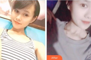 深圳?，斄猪槼毖劭漆t(yī)院江英整形價(jià)格表附開內(nèi)眼角案例展示