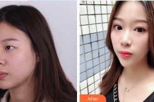 深圳華夏眼科醫(yī)院吳銳鋒整形價(jià)格表附外切祛眼袋案例展示