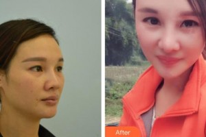 懷化市第一人民醫(yī)院廖明星整形價格表附假體隆鼻案例展示