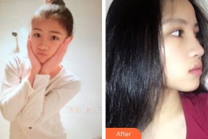 懷化市第一人民醫(yī)院申志云整形價格表附鼻部綜合案例展示