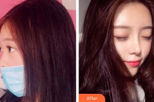 懷化市第一人民醫(yī)院吳文潔整形價格表附肋軟骨隆鼻案例展示