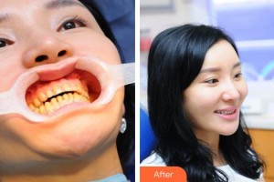 東莞特美口腔門診部王濟良整形價格表附美白貼片案例展示