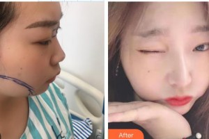 東莞韓美整形醫(yī)院黃中志整形價格表附膨體隆鼻案例展示