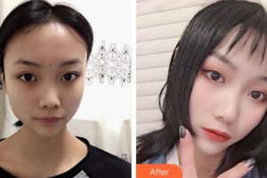 東莞華美醫(yī)療美容醫(yī)院郭思婷整形價格表附鼻部綜合案例展示