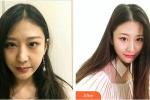 東莞維多利亞整形醫(yī)院周俊整形價格表附鼻部綜合案例展示