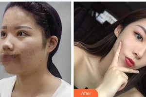 東莞非凡美容醫(yī)院李青整形價格表附鼻部綜合案例展示