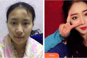 東莞百佳瑪麗亞婦產(chǎn)醫(yī)院謝本勇整形價格表附鼻部綜合案例展示