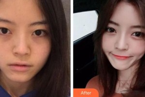 東莞愛爾眼科醫(yī)院葉健章整形價格表附鼻部綜合案例展示
