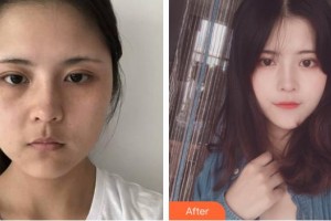 東莞同濟光華醫(yī)院口腔科楊茂整形價格表附鼻部綜合例展示