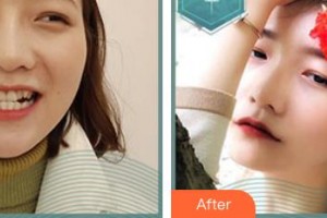 東莞同濟光華醫(yī)院口腔科龍亞香整形價格表附隱形托槽矯正案例展示