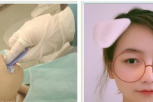 東莞同濟光華醫(yī)院口腔科譚娟玲整形價格表附牙齒隱形矯正案例展示