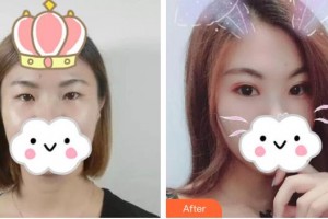 東莞華廈眼科醫(yī)院趙聰梅整形價(jià)格表附眼部綜合案例展示