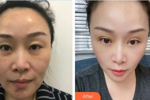 東莞愛爾眼科醫(yī)院王虎整形價(jià)格表附眼部綜合案例展示