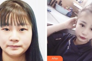 東莞光明眼科醫(yī)院陳家祺整形價(jià)格表附眼部整形雙眼皮案例展示