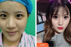 東莞光明眼科醫(yī)院陳龍山整形價(jià)格表附雙眼皮案例展示