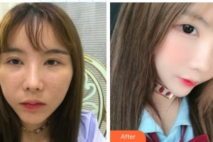 東莞光明眼科醫(yī)院崔帥整形價(jià)格表附下瞼整形案例展示