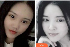 東莞市中醫(yī)院眼科余日成整形價(jià)格表附下瞼整形案例展示