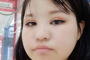 上海時光整形外科醫(yī)院下頜角手術果太好了