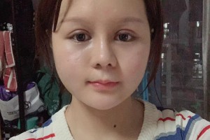 上海時光整形外科醫(yī)院李靜林醫(yī)生顴骨手術果太好了