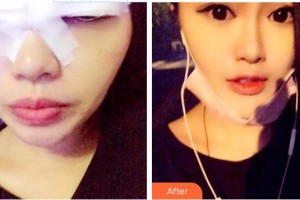 景德鎮(zhèn)市第二人民醫(yī)院眼科董曉明整形價格表附切開雙眼皮案例展示