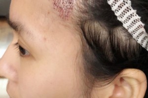 珠海人民醫(yī)院植發(fā)果怎么樣附2021價(jià)格表專家介紹