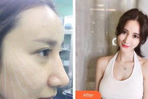 溫嶺醫(yī)美佳醫(yī)療美容診所金炳健整形價格表附埋線提升案例展示