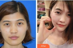 溫嶺醫(yī)美佳醫(yī)療美容診所楊金君整形價格表附激光美膚激光案例展示