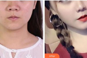 延吉尹世整形美容醫(yī)院尹慶愛(ài)整形價(jià)格表附激光美膚激光案例展示