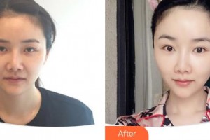 延吉董昌林醫(yī)學(xué)美容醫(yī)院董蓮花整形價(jià)格表附埋線提升案例展示