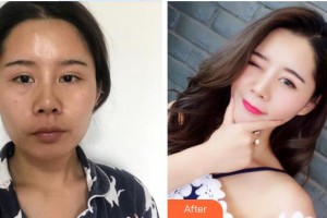 延安儷人醫(yī)院整形美容中心王英俊整形價格表附肋軟骨隆鼻案例展示