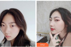 延安大學(xué)附屬醫(yī)院燒傷整形科袁新建整形價格表附鼻修復(fù)案例展示