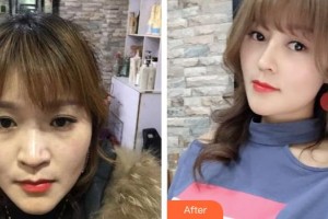 延安大學(xué)附屬醫(yī)院燒傷整形科李明整形價格表附肋軟骨隆鼻例展示