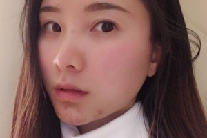 鄭州美立方醫(yī)院怎么樣？熱瑪吉2021價(jià)格分享附案例