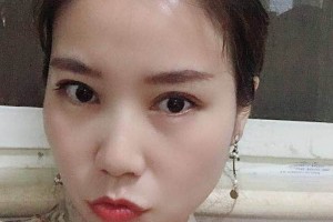 三亞人民醫(yī)院割雙眼皮果好不好附案例|2021價格表